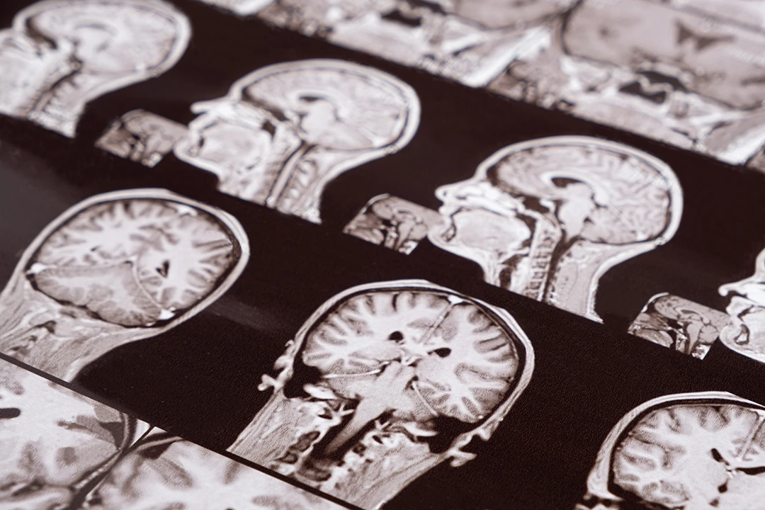 Córdoba reúne a la neurocirugía internacional con el paciente y el futuro como eje del congreso SENEC 2026